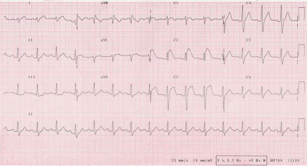 Brugada sendromu nedir?