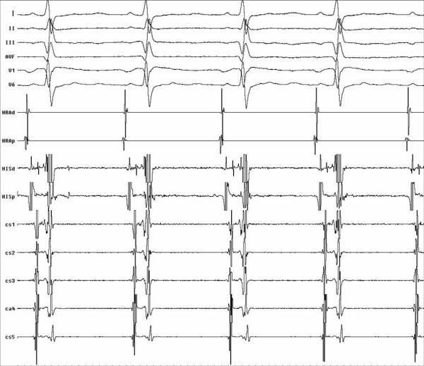 Elektrofizyolojik Çalışma