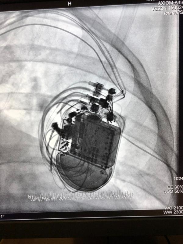 Kalp pili biter mi? Ömrü ne kadardır? Bittiği nasıl anlaşılır? Değiştirilebilir mi?